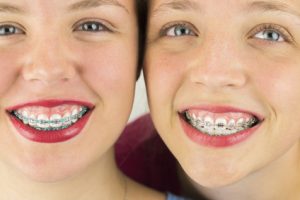 braces for kids