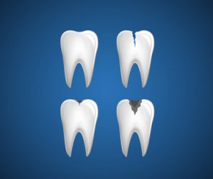 cracked teeth treatment