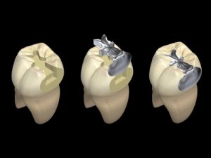 inlay and onlay restorations