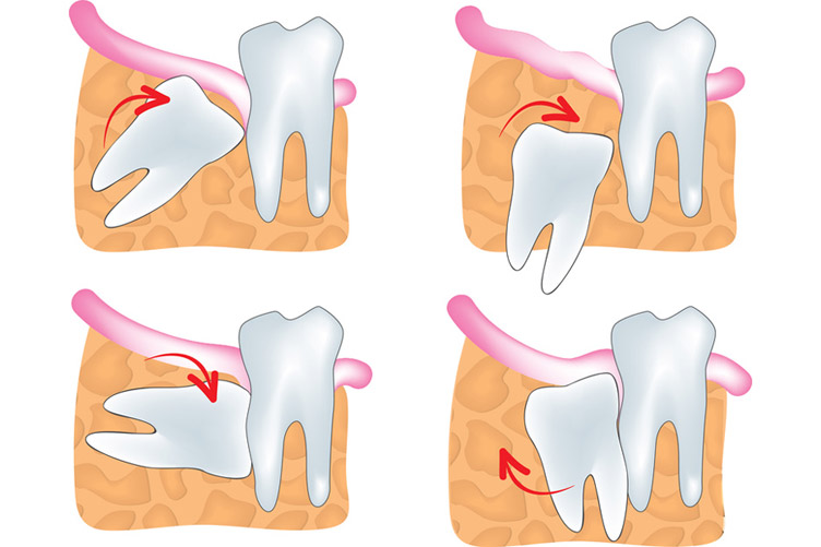 Oral surgery : Wisdom teeth extraction at Burnaby Dental Studio